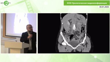 Телегин И.В. - Непрямой LS уретероцистанастомоз по Демелю+псоас хитч у больной с идиопатической стриктурой мочеточника