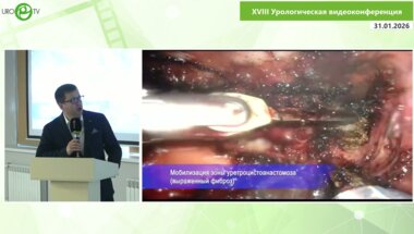 Глухов В.П - Робот-ассистированная буккальная пластика стеноза уретроцистоанастомоза