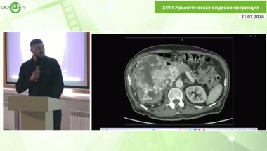 Заставский В.А. - Лапароскопическая нефрэктомия с тромбэктомией II уровня