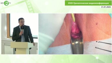 Кубин Н.Д., Шульгин А.С., Сучков Д.А., Шахалиев Р.А. - Имплантация среднеуретрального синтетического слинга позадилонным способом