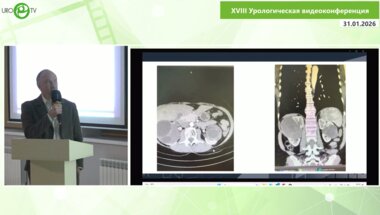 Рева С.А., Яковлев В.Д., Арнаутова К.А., Арнаутов А.В., Петров С.Б. - Очень сложная резекция двусторонних кист почек Bosniak III