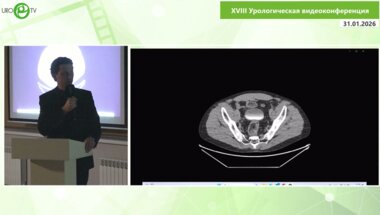 Степанченко В.С. - Лапароскопическая резекция мочевого пузыря при опухоли урахуса
