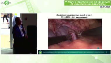 Кочетов А.Г. - ICG и сложные лапароскопические операции в урологии