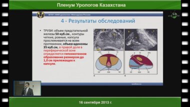 Серебряный С.А. «Разбор клинического случая пациента с протяженной стриктурой (облитерацией) уретры»