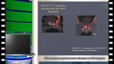 Андабеков Т.Т. - "Тактика лечения больных с биохимическим рецидивом после радикальной простатэктомии"
