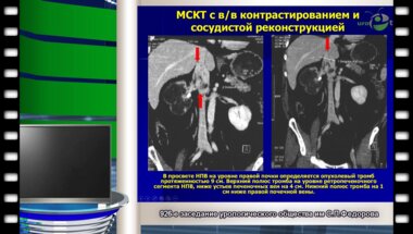 А.Д.Белов - "Возможности эндопротезирования НПВ в лечении больных почечноклеточным раком, осложненным опухолевым тромбозом"