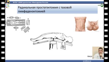 Войтко Д.А. - "Клинический случай пациента с РПЖ"