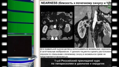 Медведев В.Л. - "Выбор оперативного вмешательства при раке почке"