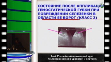 Тимербулатов М.В. - "Лапароскопические операции в хирургии селезенки"