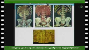 Токтабаянов Б.Г. - "Перкутанная эндоскопическая ретроперитонеальная криоаблация опухолей почек"