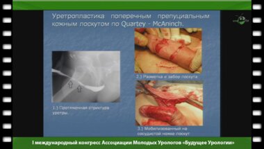 Сокольщик М.М. - "Наш опыт реконструкции передней уретры"