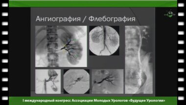Волков С.В. - "Возможности эндоваскулярной хирургии в урологии"
