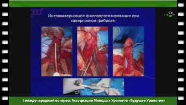 Садакова И.В. - "Комбинированная методика лечения пациентов с кавернозным фиброзом"