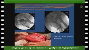 Живов А.В. - "Реконструктивная хирургия уретры как «выпрямить» хирургическую »кривую обучения» («surgical learning curve»)"