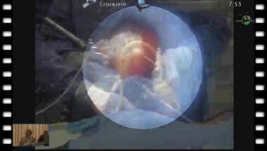 Trinchiery A. - Видео лежа PCNL