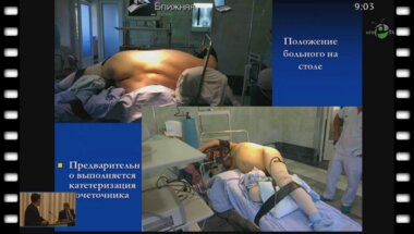 Аюбов Б.А. - "Ретроперитонеоскопические и лапароскопические вмешательства при МКБ"