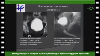 Яцина А. - "Уродинамика артифициального мочевого пузыря"