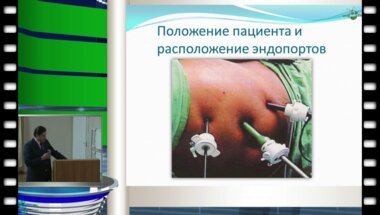 Аль-Шукри А.С. - "Наш опыт применения лапароскопического чрезбрызжеечного доступа при первичной и вторичной пиелопластике слева"