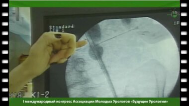 Установка уретерального стента "Memokath"