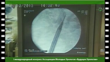 Чрескожная нефролитотомия