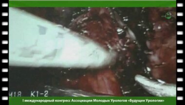 Лапароскопическая радикальная нервосберегающая простатэктомия