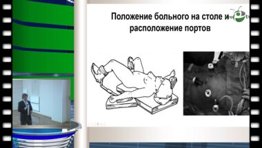 Петров С.Б. - "Первый опыт лапароскопических цистэктомий с интракорпоральным формированием илеокондуита в лечении рака мочевого пузыря"