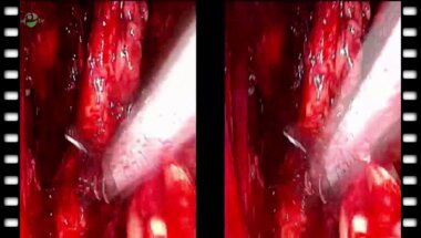 Видеоэндоскопическая экстрафасциальная радикальная простатэктомия. Тазовая лимфоаденэктомия (3D)