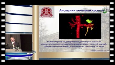 Цариченко Д.Г. - "Трехмерная анатомия при заболеваниях аномалийных почек"