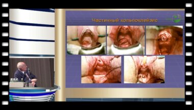 Лоран О.Б. - "Лучевые повреждения органов мочеполовой системы при онкогинекологических заболеваниях"