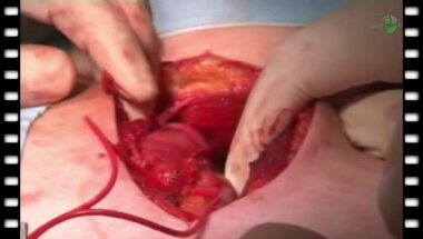 П.С.Кызласов - Микрохирургическая реваскуляризация полового члена по Virag