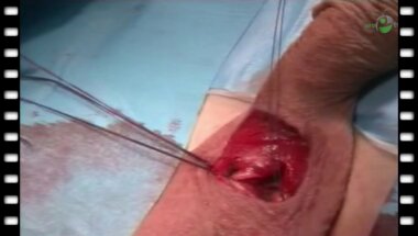 М.М. Сокольщик - Имплантация пластического протеза Spectra