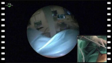 Гаджиев Н.К. -  "Стандартная перкутанная нефролитотрипсия»