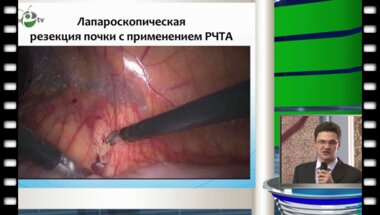 А.С. Калпинский - Лапароскопические и малоинвазивные технологии у больных раком почки