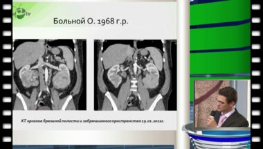 Клинический случай - первично-множественный синхронный рак почек