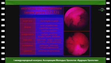 Мартов А.Г. - "Эндоскопические возможности диагностики рака мочевого пузыря"
