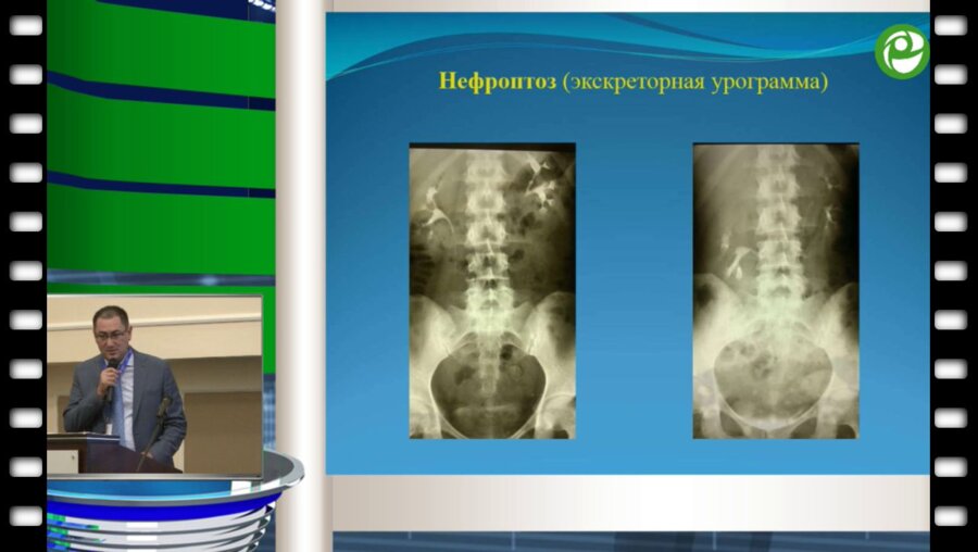 Муратов Т.М. - Наш опыт лапароскопических операций в урологии