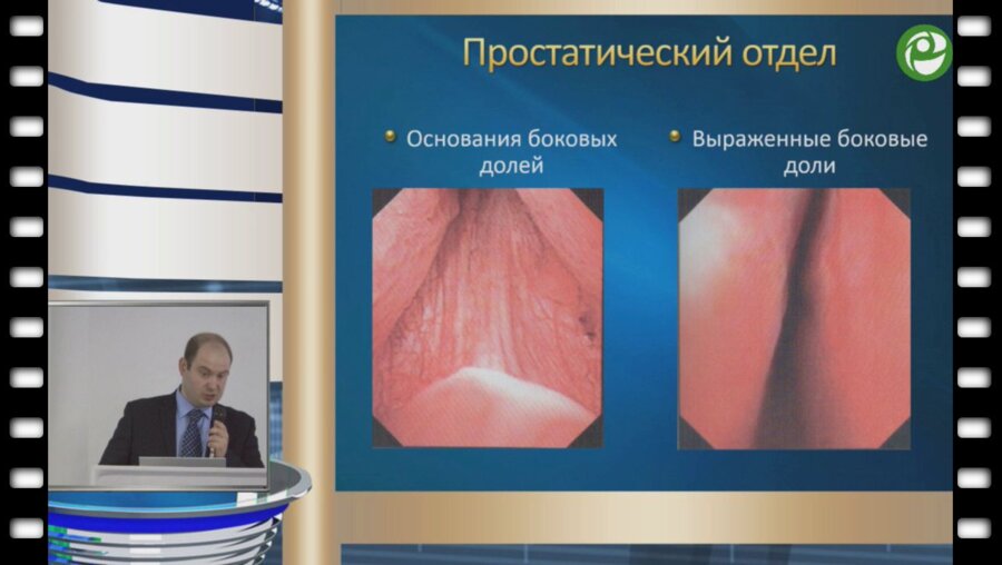 Ергаков Д.В. - ТУР простаты
