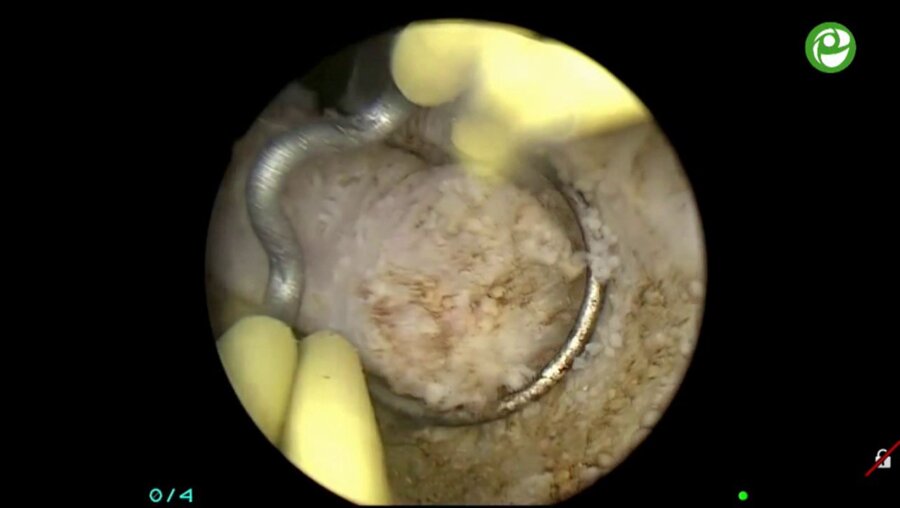 Операция "Биполярная ТУР простаты"