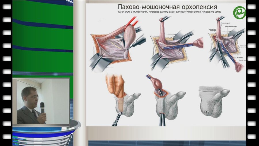 Игнатьев Р.О. - Хирургические методы лечения крипторхизма у детей