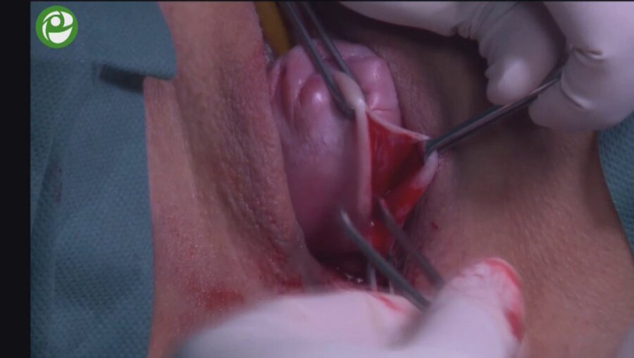 Реконструкция тазового дна при цистоцеле 3 ст. с апикальным пролапсом 3-4 ст.