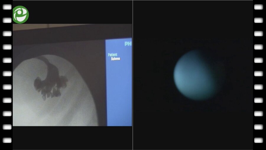 Операция мини перкутанная нефролитотрипсия справа