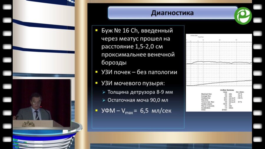 Митусов В.В. - Уретропластика по ASOPA протяженной пенильно - бульбозной стриктуры уретры доступом Аустони