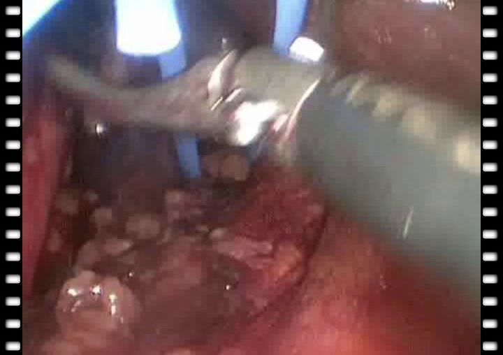 Гулиев Б.Г. - Лапароскопическая геминефрэктомия справа