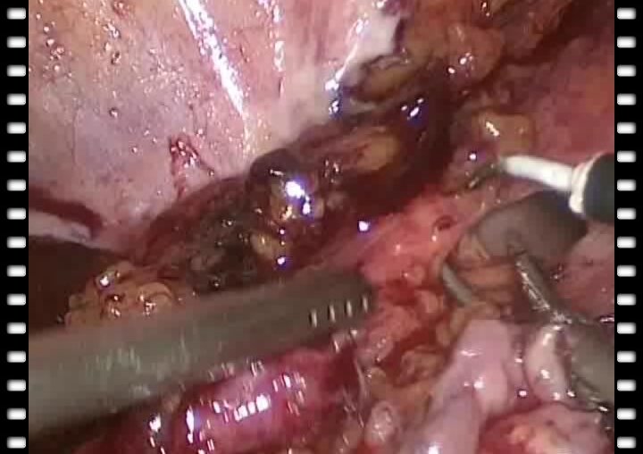 Гулиев Б.Г. - Лапароскопическая процедура Боари