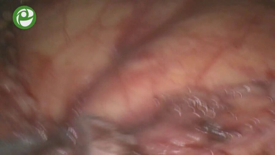 Лапароскопическая монопортовая нефрэктомия