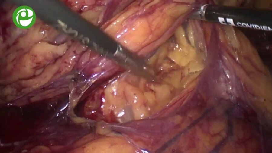 Лапароскопическая геминефруретерэктомия левой половины подковообразной почки