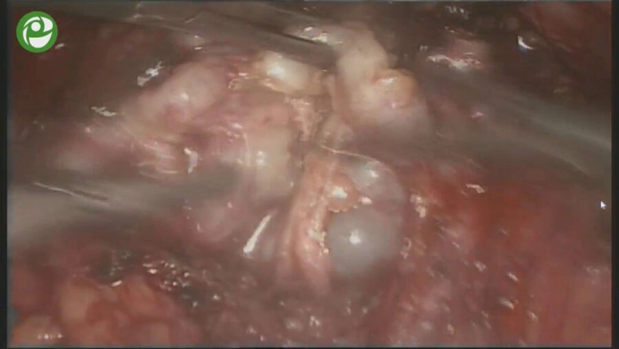 Экстраперитонеальная видеоэндоскопическая радикальная нервсберегающая простатэктомия