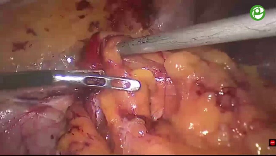 Лапароскопическая резекция правой почки