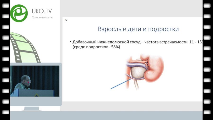 Коварский С.Л. - Опыт применения неразобщающей пиелопластики при гидронефрозе у детей