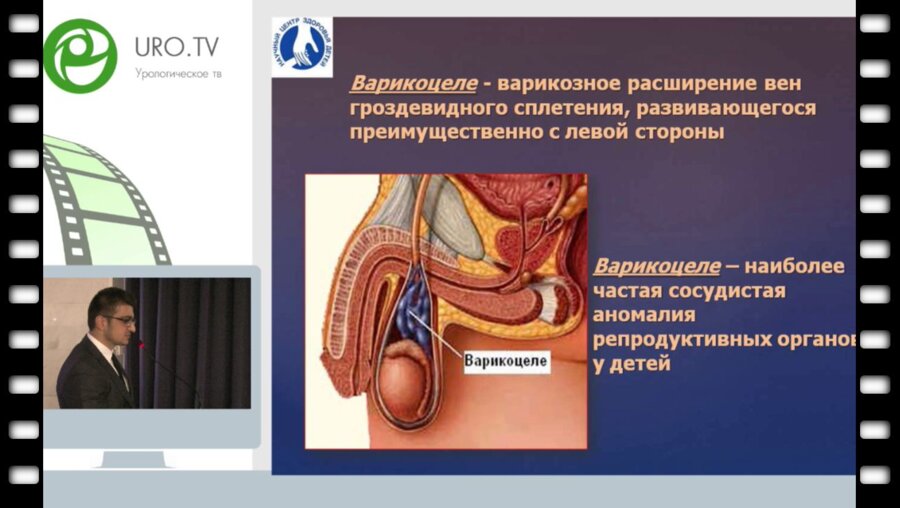 Тарзян А.О. - Изучение состояния гематотестикулярного барьера у подростков с варикоцеле